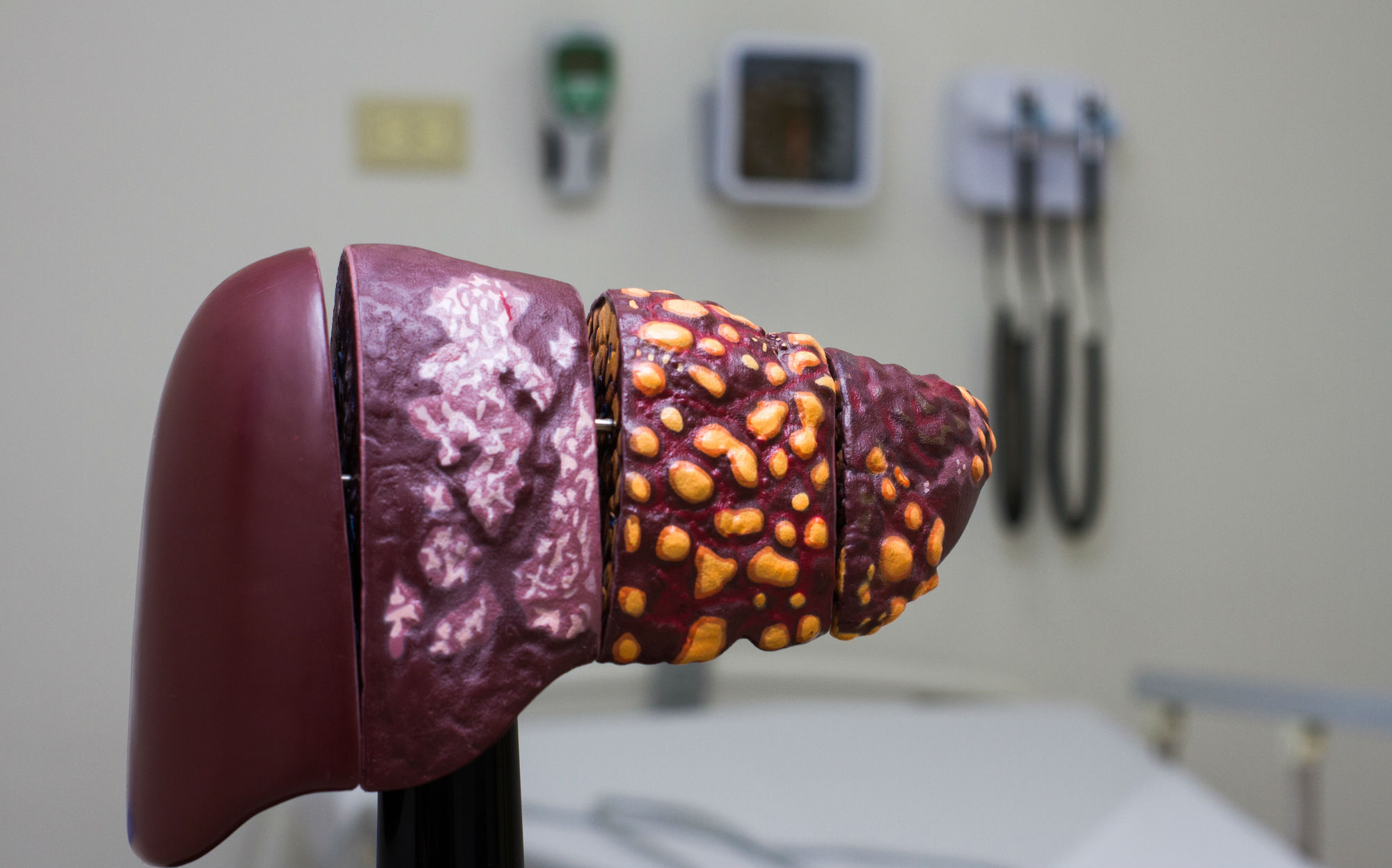 Prevención y diagnóstico de las hepatitis virales en la UANL