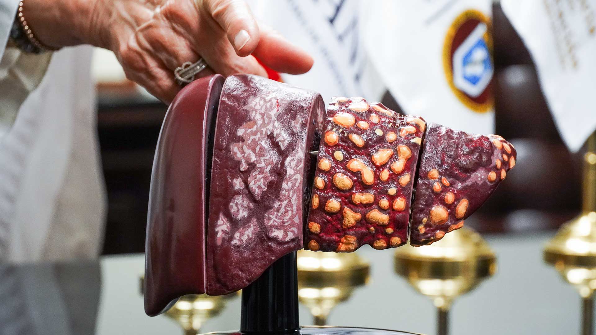 Refuerza HU estrategias para prevenir las hepatitis virales